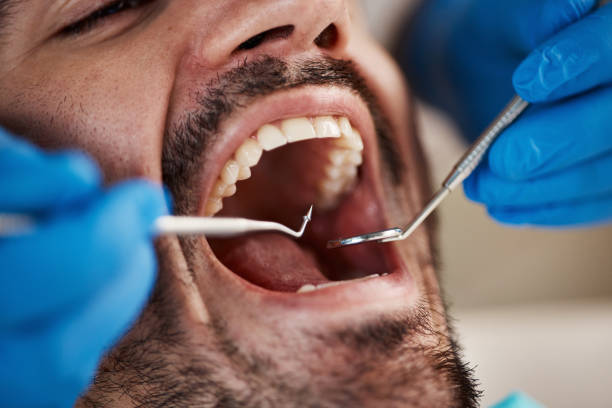 Best Emergency Tooth Extraction in Belton, SC