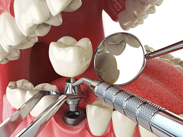 Best Emergency Treatment for Dental Infections or Abscesses in Belton, SC